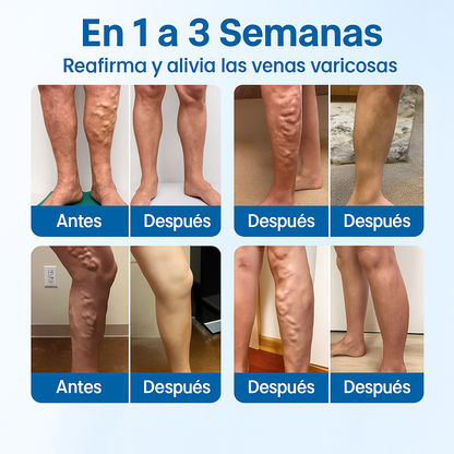 Timilk® VeinGuard – Spray Herbal para Várices 2X1